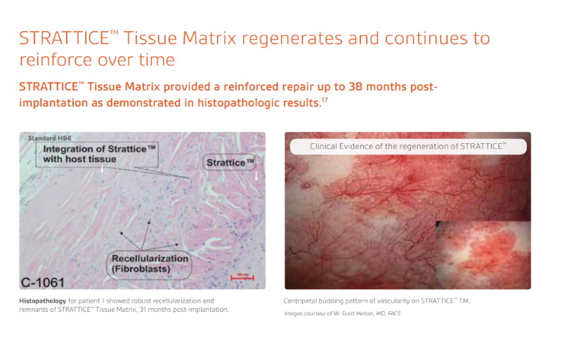 Hernia Mesh Injury